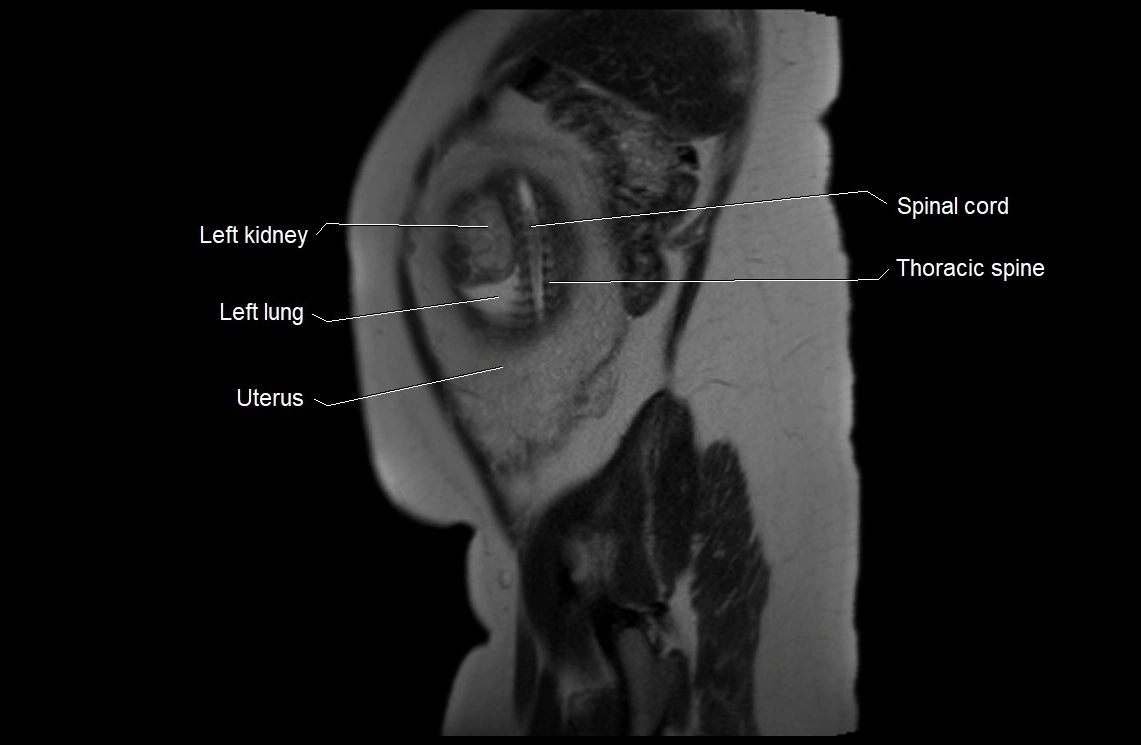 MRI fetal anatomy sagittal image 5.webp